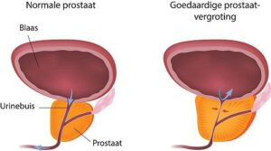 afbeelding Benigne prostaat hyperplasie
